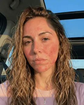 Júlia Paes - Pele Inflamada